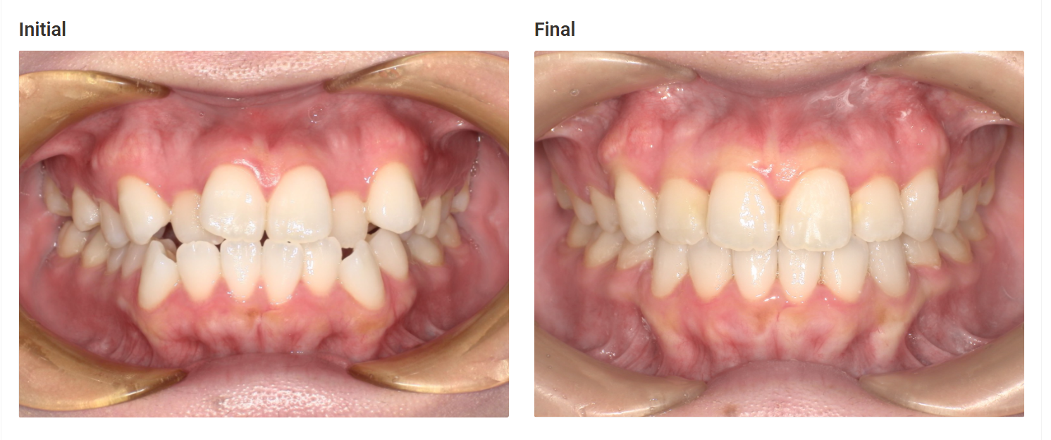 Crowded teeth corrected with clear aligners in Patna - before and after
