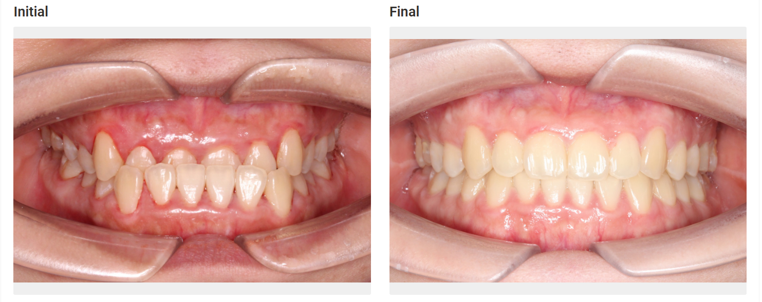Overbite corrected with ceramic braces in Patna - before and after