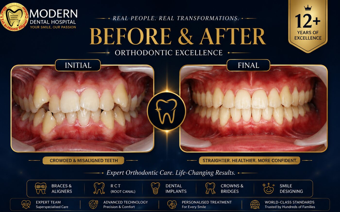 Real orthodontic before and after case Patna second angle