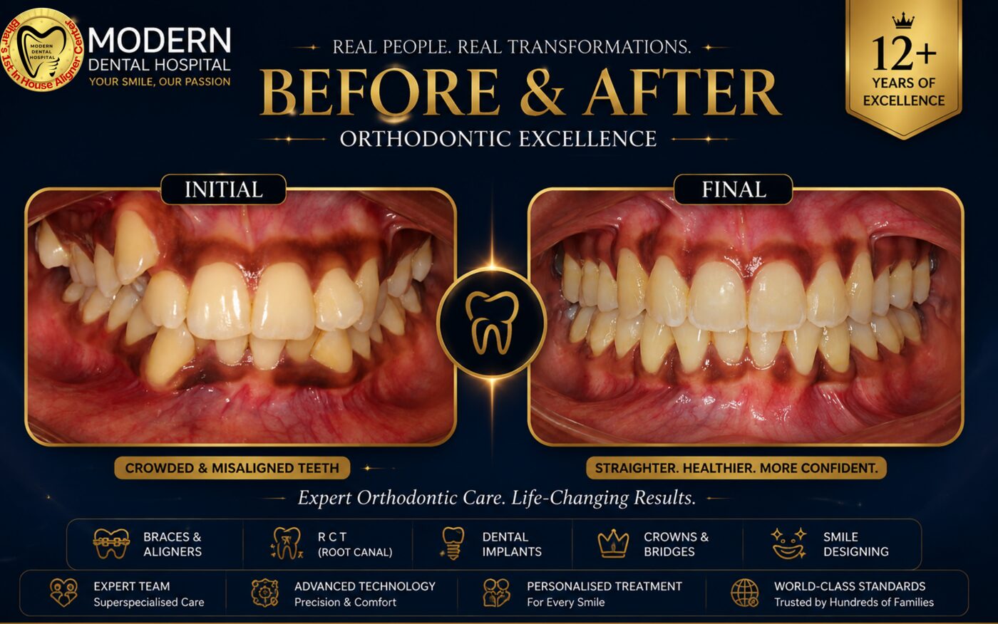 Real braces before and after front teeth case Patna